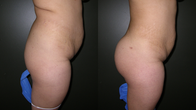 Brazilian Butt Lift - This patient was unhappy with the size of her buttocks and also with fatty tissue on her back and posterior flanks. She underwent liposuction of the posterior flanks and back with transfer to her buttocks.