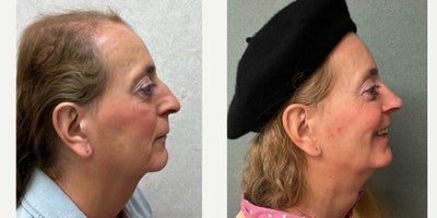 65-74 year old woman treated with Adam's Apple Reduction, Brow Bone Reduction, Brow Lift, Septoplasty, Rhinoplasty, Lip Lift, Ch - This lady underwent facial feminization surgery including forehead feminization, nasal feminization, cheek augmentation, chin feminization and adams apple reduction.