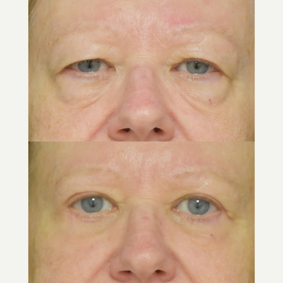 65-74 year old woman treated with Eyelid Surgery, Double Eyelid Surgery - 65-74 year old woman treated with Eyelid Surgery, Double Eyelid Surgery