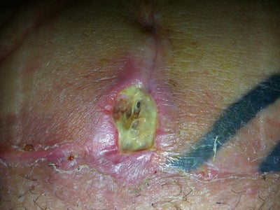 wound scar tuck tummy inside open looks