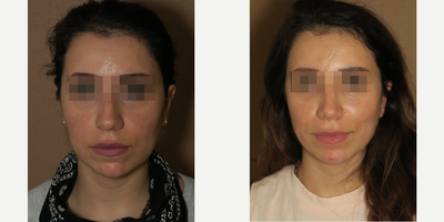 Woman treated with Rhinoplasty - Woman treated with Rhinoplasty