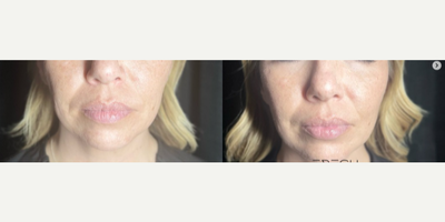 Woman treated with Cheek Fillers - Woman treated with Dermal Fillers, Chin Filler, Cheek Fillers