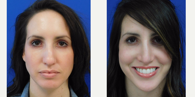 30 yo desired smaller nose - She desired dorsal hump removal and refinement of tip