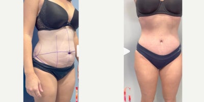35-44 year old woman treated with Tummy Tuck - 35-44 year old woman treated with Tummy Tuck