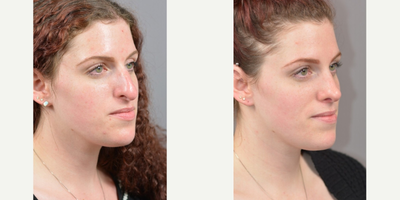 18-24 year old woman treated with SeptoRhinoplasty - Results shown are at 5 weeks post-op.Before: The patient has a drooping nasal tip and hanging columella. Her nose is too large for her face and too long.After: The tip is rotated and the nose shortened. The hanging columella is fixed.