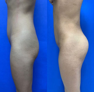 Woman treated with Butt Implants - Woman treated with 379cc Butt Implant combined with Fat Transfer to the Hips