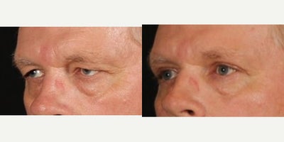 55-64 year old man treated with Eyelid Surgery - Our patient is healing up from his upper blepharoplasty just six weeks after his surgery. We are shooting for two things: improve eye strain and fatigue from heavy upper eyelids and get a more youthful, alert look. He is already on to bigger and better things. Thank you to him for allowing us to share!