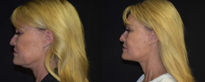 55-64 year old woman treated with Facelift - Lower Face and Necklift; Upper Blepharoplasty; Fat Grafting to Cheeks; Perioral Dermabrasion