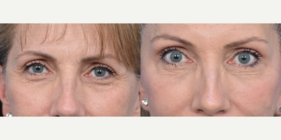 55-64 year old woman treated with Brow Lift - This patient was interested in improving the appearance of the heaviness in her brows. A Brow Lift was performed to address her concerns.