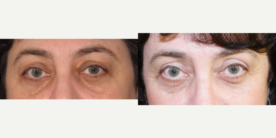 45-54 year old woman treated with Eyelid Surgery - removal of cholesterol in the eyelids- xanthelasma removal