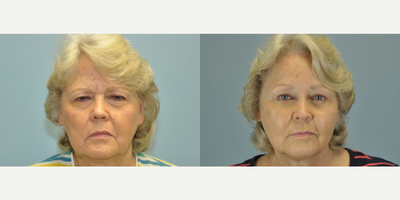 72 year old woman treated with Ptosis Surgery - This 72 year old patient suffering from levator ptosis had bilateral upper and lower blepharoplasty, bilateral canthopexy, and endoscopic brow lift.