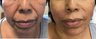 55-64 year old woman treated with Juvederm - 55-64 year old woman treated with 2 syringes ofJuvederm Vollure to nasolabial folds and cheeks