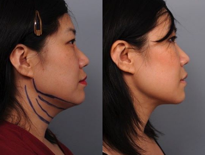 Woman treated with Radiesse - Woman treated with Radiesse