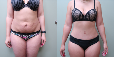 25-34 year old woman treated with Tummy Tuck - abdominoplasty with muscle plication and liposhaping