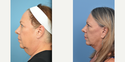 55-64 year old woman treated with Facelift - This patient underwent a Neck Lift to address the fullness in her neck.