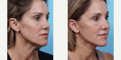 Woman treated with Facelift - Woman treated with Facelift