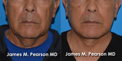 65-74 year old man treated with Facelift - 65-74 year old man treated with Facelift and Neck Lift