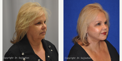 Eyelid Surgery - Eyelid Surgery