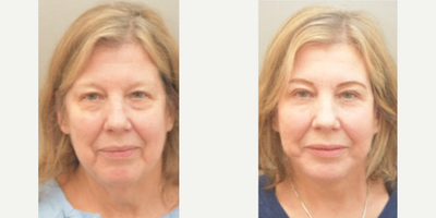 66 year old woman treated with SMAS Facelift as well as Neck Lift - 66 year old woman treated with SMAS Facelift as well as Neck Lift