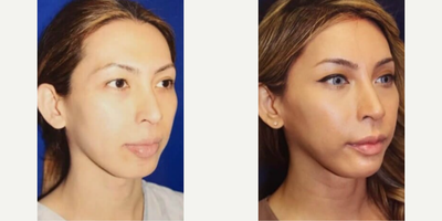 Woman treated with Forehead Reduction - Woman treated with Forehead Reduction (Hairline Advancement)