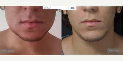 25-34 year old man treated with Chin Implant - Chin Implant