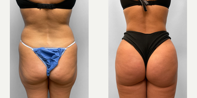 25-34 year old woman treated with Butt Lift, Liposuction - This woman in her early thirties met with Dr. Howell to discuss her interest in body contouring. SmartLipo to the abdomen, flanks and saddle bag areas along with BBL fat injections to the lateral buttocks would help her achieve her desired appearance while being a less invasive option for surgery. She has nice contours to her abdomen, flanks and buttocks and is pictured before and three months after surgery.