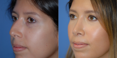 18-24 year old woman treated with Rhinoplasty - Nice rhinoplasty result with a straighter nose, no bump, and refined tip.