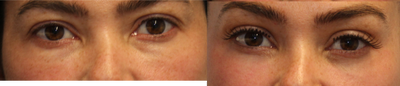 Lower blepharoplasty with nanofat grafting - This woman wanted more permanent results than what fillers could offer so she opted for transconjunctival lower blepharoplasty with fat grafting including nanofat and fractional laser resurfacing.