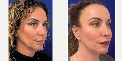 45-54 year old woman treated with Facelift - My 49 year old patient 3 months post a Facelift, Neck lift, Fat Transfer, Upper Blepharoplasty and CO2 laser. You can see her jawline, lower face and neck are nicely defined and contoured, she has more volume in the mid face from the fat transfer, the jowling is no longer and the shape of her mouth has remained the same, she has more eyelid space and her skin tone is more even and smoother.