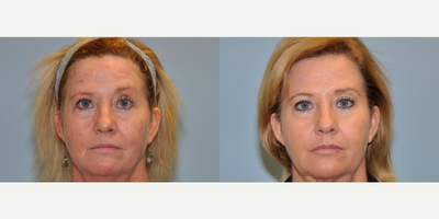 45-54 year old woman treated with Laser Treatment - This patient had laser treatment to her full face.