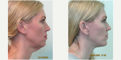 45-50 year old woman treated with Lower Facelift, Necklift, and Silicone Chin Implant - This active mother of 2 presented with the concerns of genetic premature aging of her jawline and neck. She wished for her jowls and submental (under the chin) tissue to be more shapely and not as heavy appearing. Examination revealed significant laxity and fullness of her jawline and neck tissue, along with slight underdevelopment of her mandible (chinbone). We decided to perform a lower facelift, necklift, and chin augmentation (with a silicone implant) in our Center under local anesthesia with oral sedation with valium. Procedure time was approximately 2 1/2 hours and she required prescription pain pills for only 2 days. Her result demonstrates an improved profile with a sharper, and less heavy appearing, jawline.