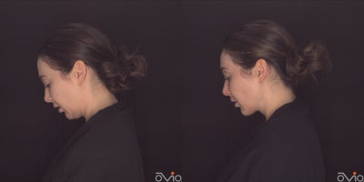 25-34 year old woman treated with MyEllevate - 25-34 year old woman treated with MyEllevate