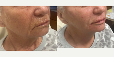 67 year-old treated with filler to the lips , cheeks, and chin - Woman treated with filler to the Lips, Cheeks, Nasolabial Fold, Chin, Marionette Lines with Radiesse and Ravenesse Versa.