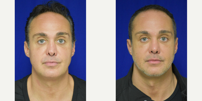 35-44 year old New Orleans man treated with Voluma and Vollure - Combination of Volluma and Vollure to treat the periorbital region with result of improved balance and decreased hollowness throughout the cheek and under eye areas. He also underwent revision rhinoplasty 6 weeks prior to filler injections.