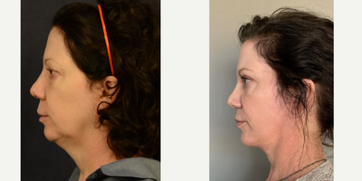 45-54 year old woman treated with Mini Facelift - Female Mini Facelift 3 months post op