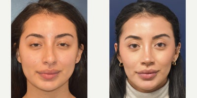 2534 year old woman treated with Rhinoplasty, Septoplasty - A woman in her 20s, one-year post-op rhinoplasty. This patient had a dorsal hump, bulbous tip, over-projected tip, tip asymmetry, and a drooping tip. Tip elevation, dorsal hump reduction, tip refinement, and nasal tip deprojection were performed. The overall goal is a conservative change of her nose to result in a natural appearance of the nose which does not droop when smiling and improves breathing.