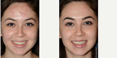 18-24 year old woman treated with Skin Rejuvenation - Skin rejuvenation with microneedling. Follow-up photo taken 7 months after the procedure.