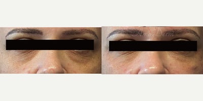 45-54 year old woman treated with Juvederm, Volbella, Voluma - 4D Under Eye Lift - Treatment of dark circles & bags under eyes and cheek restoration with Belotero, Restylane, Volbella and Voluma