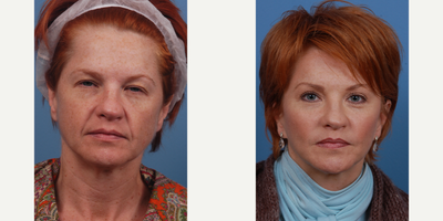 45-54 year old woman treated with Cheek Augmentation - This patient had cheek implants and Upper eyelid blepharoplasty.