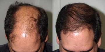 Hair Transplant