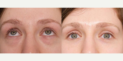 Woman treated with Eyelid Surgery - Woman treated with Eyelid Surgery