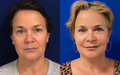 55 year old woman treated with Eyelid Surgery - 55 year old 1 month and 5 months post facelift, necklift, upper blepharoplasty, lower eyelid skin pinch, fat transfer, and full face co2 laser.