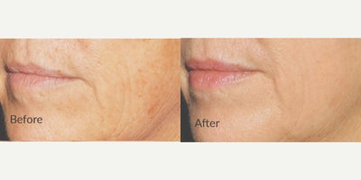 45-54 year old woman treated with LaseMD - Treated with LaseMD