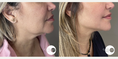 35-44 year old woman treated with Ultherapy - This is a non invasive treatment with microfocused ultrasound technology and visualization. Helps achieve a fresher, more youthful look from the eyebrows to the cleavage. Improves skin appearance. Generates skin retraction. Optimize collagen production. Improves tone and texture. Oxygenates and provides hydration to the treated areas.