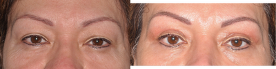 Blepharoplasty - Blepharoplasty before and after.