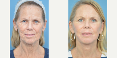 55-64 year old woman treated with Chemical Peel - This patient was concerned with the aged appearance and texture of her skin. A chemical peel was performed to address her concerns.