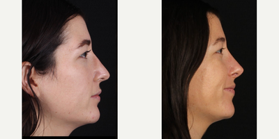 25-34 year old woman treated with Revision Rhinoplasty - Rhinoplasty B&A - performed with rib cartilage grafting.