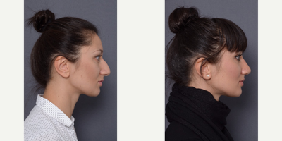 28 year old woman treated with Rhinoplasty - 28 year old female who underwent a rhinoplasty.