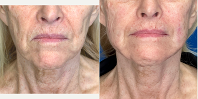 65-74 year old woman treated with Endolift, Nonsurgical Facelift, Miracu, Nonsurgical Neck Lift, Thread Lift - Endolift Laser tightens lax tissue, contours and stimulates your collagen. Using the Endolift Laser the face, cheeks, jawline and neck were tightened, smoothed and supported with PDO Threads. This is an outpatient office procedure with minimal discomfort during or after the procedure and rapid recovery. As the entire procedure is performed through tiny pin holes. The skin continues to improve as collagen within your skin is stimulated. Not only is there a lift and contour improvement but the quality of the skin is remarkably improved.