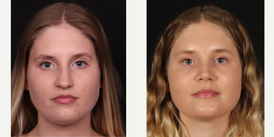 18-24 year old woman treated with Rhinoplasty - Female patient 5 weeks after rhinoplasty.
